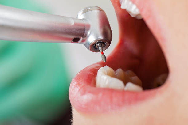 Best Emergency Dentist for Lost Fillings or Crowns in Riverside, CA